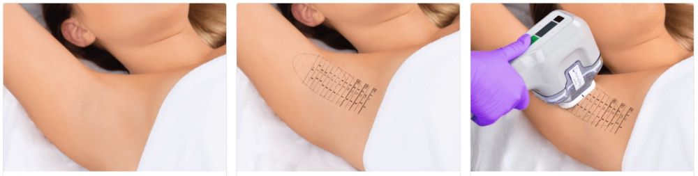 Gde uraditi miraDry tretman za prekomerno znojenje